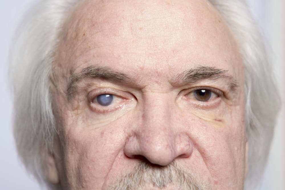 Primer plano de anciano con pelo blanco y bigote con catarata en ojo derecho